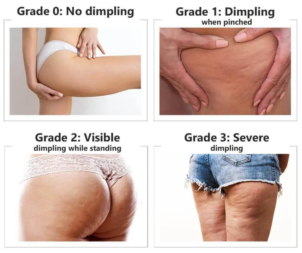 Representation of the stages of cellulite development England